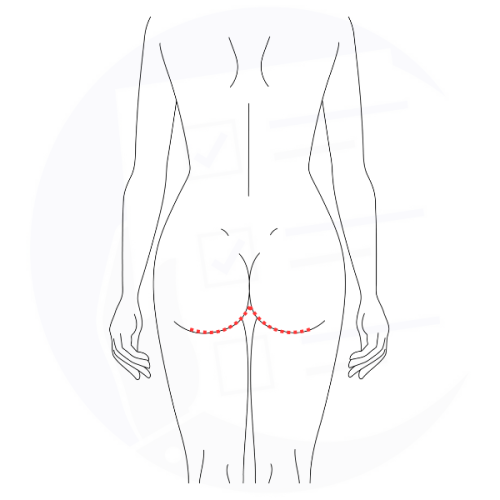Incisioni lifting cosce solco gluteo Incisioni lifting cosce solco gluteo