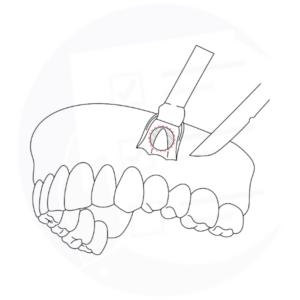 Staffe Ortodontiche Dentali Rimozione Pinza Strumento Per - Foto 9