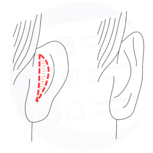 Consenso Informato Chirurgia Plastica Otoplastica Otoplastica
